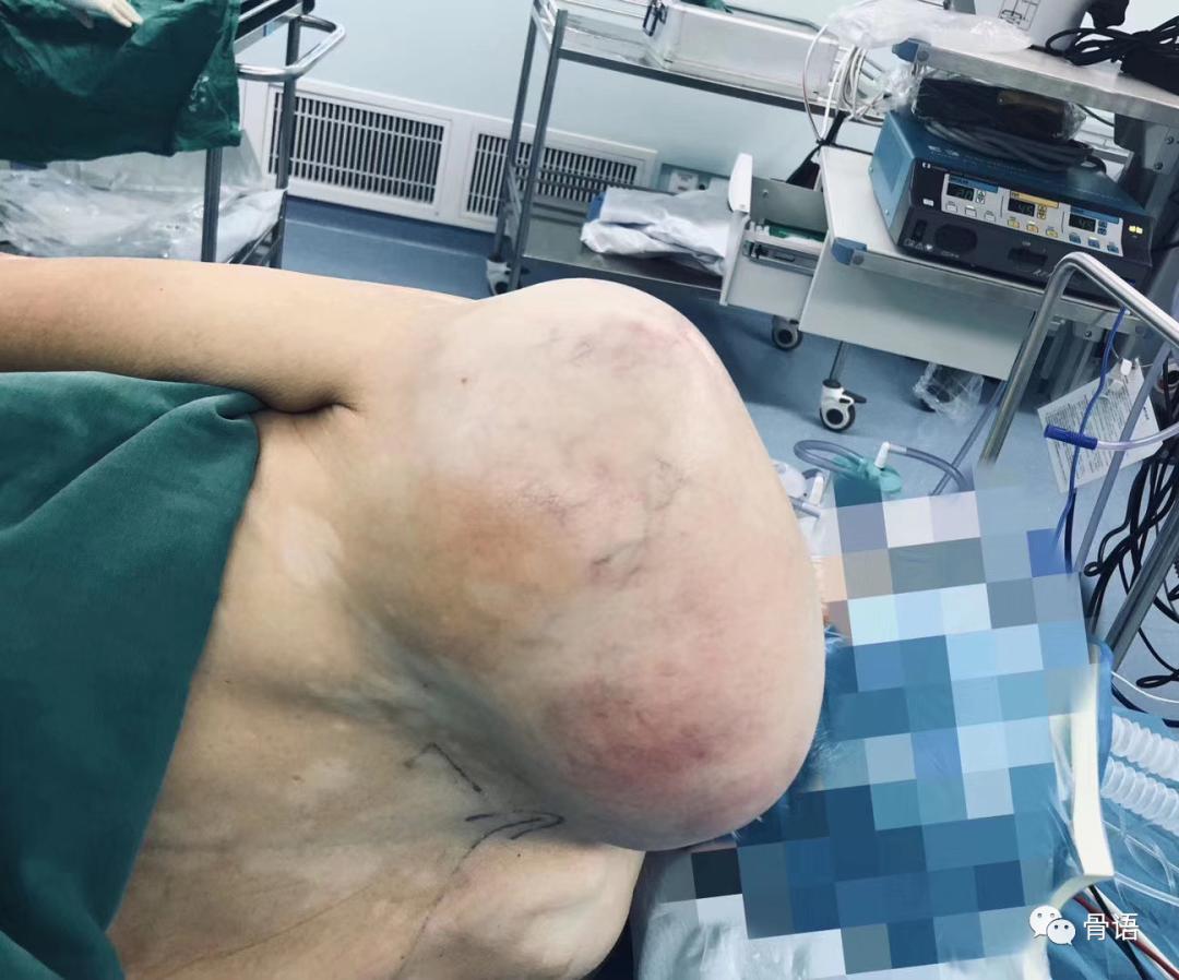 骨科恶性肿瘤,骨科软组织肉瘤是什么意思