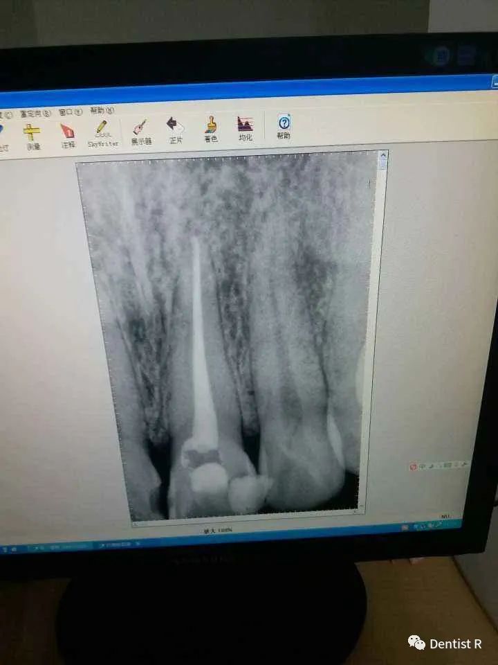 看牙为什么要拍照片,看牙拍片辐射大吗