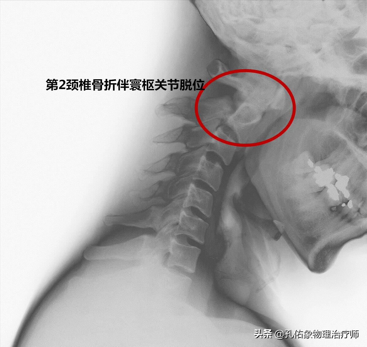 脖子按摩起来咯噔咯噔的怎么回事,转动脖子咔咔响什么原因