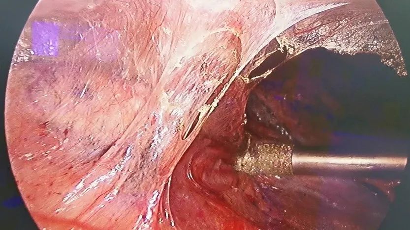 肺结节多学科联合诊疗,多学科会诊肺结节