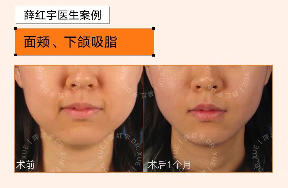 法令纹怎么改善脸部衰老,改善法令纹按摩手法视频