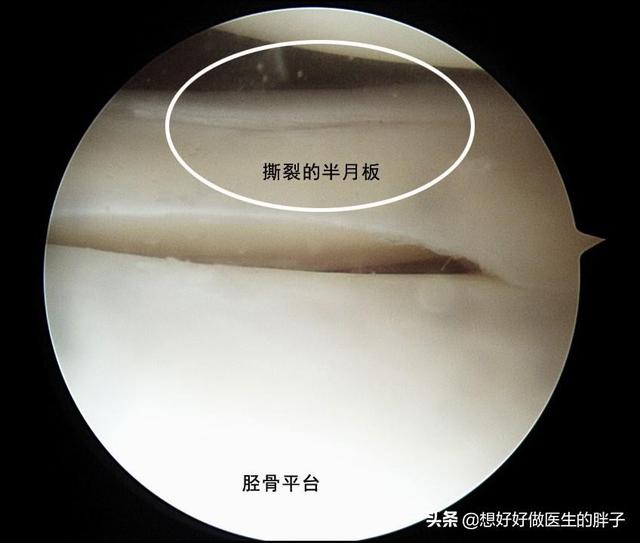 膝盖半月板撕裂还可以跑步吗,半月板撕裂未触及关节面能自愈吗