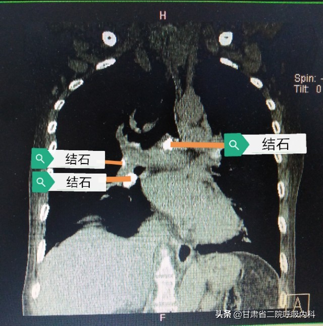 喉咙里面真的有石头吗,喉咙里会长石头吗