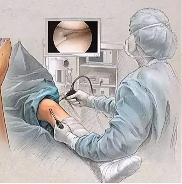 前交叉韧带断裂手术费用大概多少,前交叉韧带断裂重建手术最佳时间