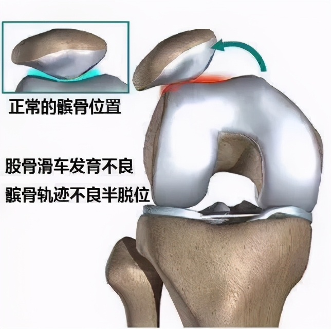 不同膝盖疼痛是暗示什么,不同位置的膝盖疼