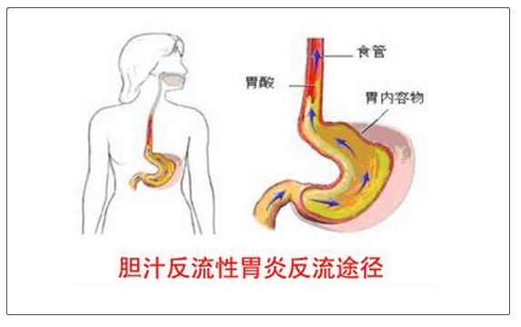 幽门螺旋杆菌胆汁反流胃炎怎么办,胆汁反流性胃炎与幽门螺杆菌有关