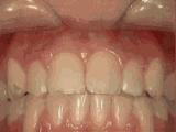 牙齿深覆合龅牙矫正过程,龅牙地包天怎么弄