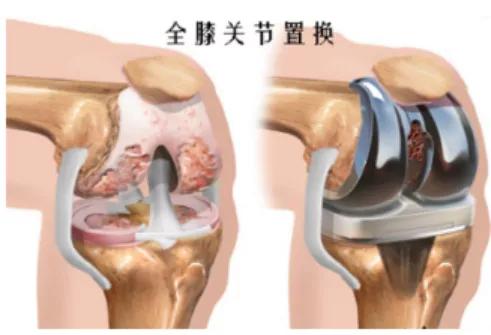 半月板损伤骨刺积液膝关节疼痛,骨刺引起的膝关节疼痛怎样治疗
