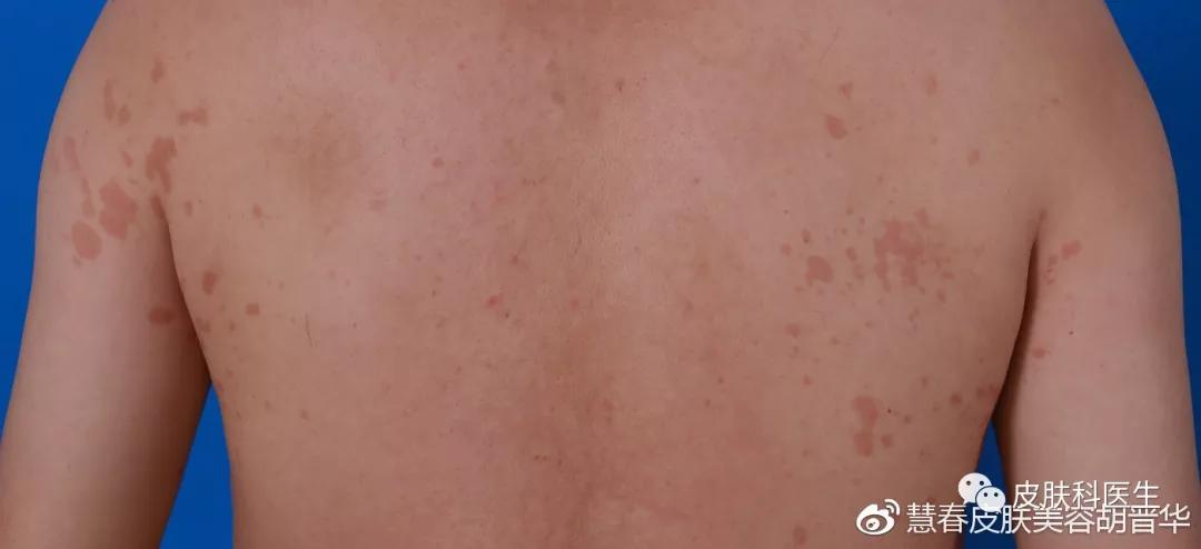 是湿疹或癣医生一眼就能辨出来吗,是不是体癣怎么检查