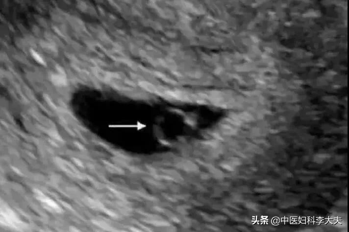 测出怀孕去医院查只看见孕囊,验出怀孕了但是又生化了