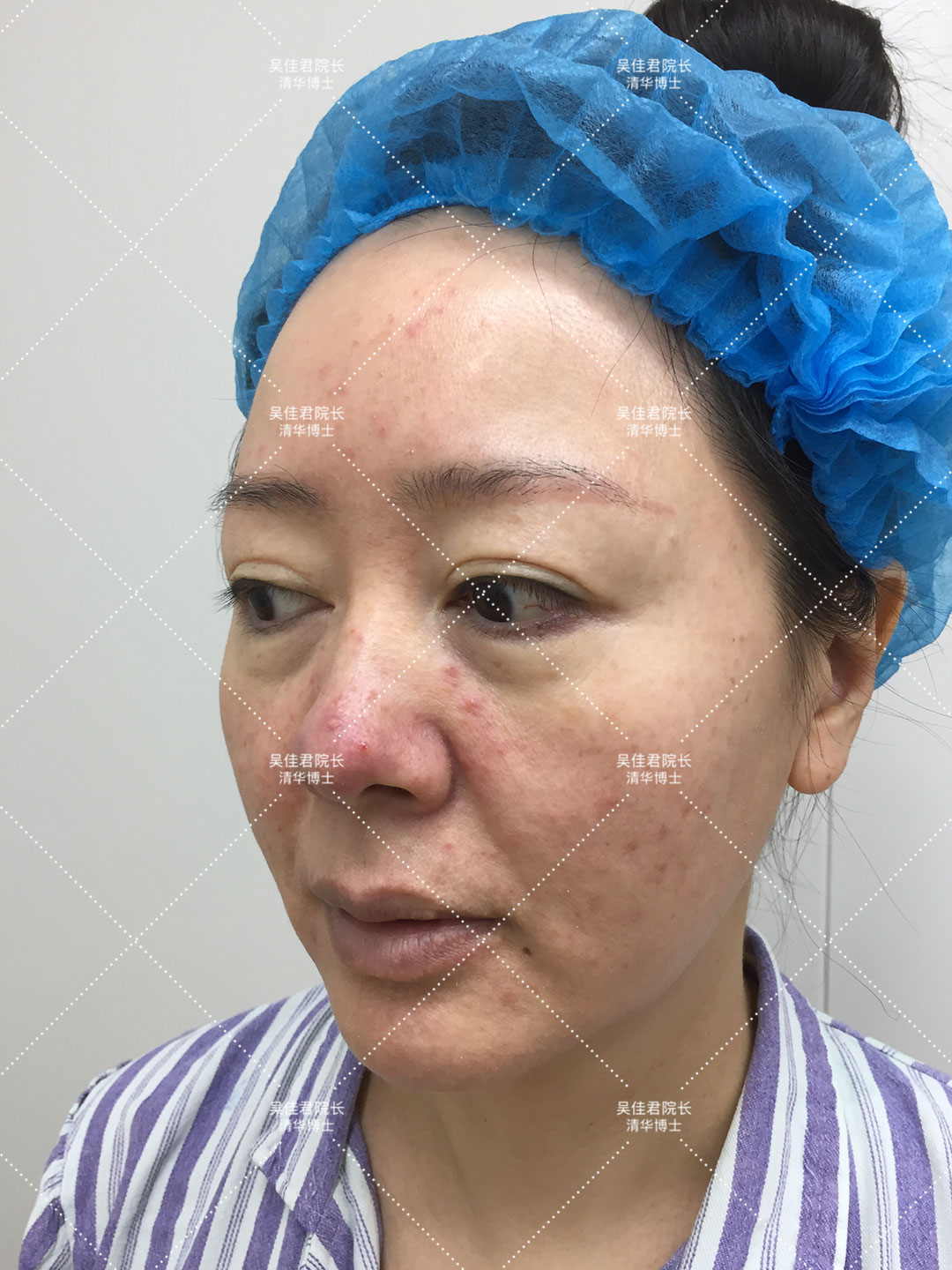 大拉皮术后50天真实感受,拉皮手术5年之后的变化