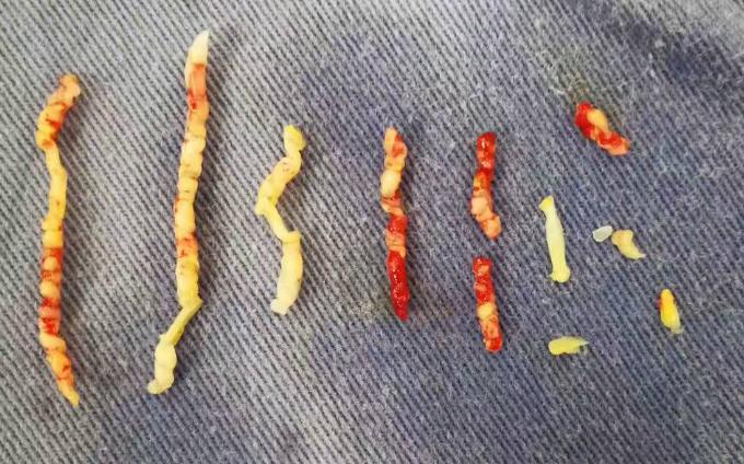 血管被堵怎么办？别怕！微创介入诊疗已有多种腔内开通手段！