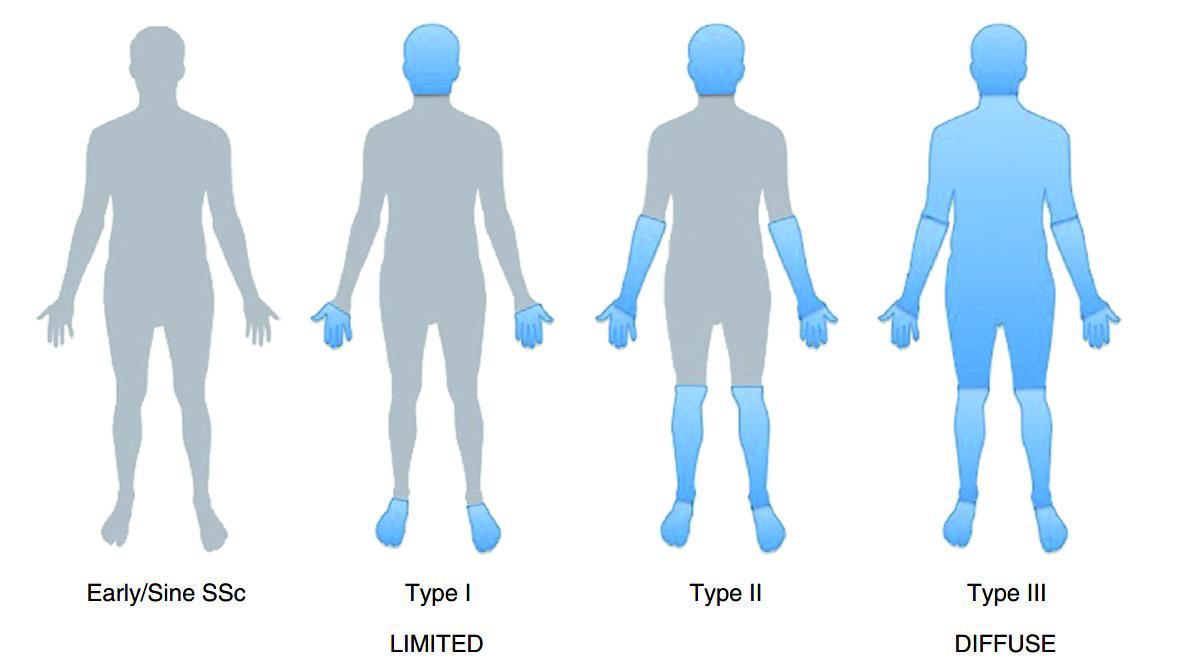 系统性硬化症/硬皮病是什么样的疾病?