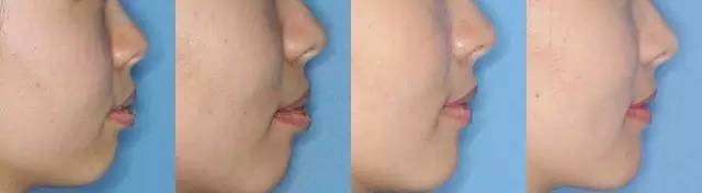 为什么医生不建议牙齿矫正呢,为什么医生不建议矫正牙