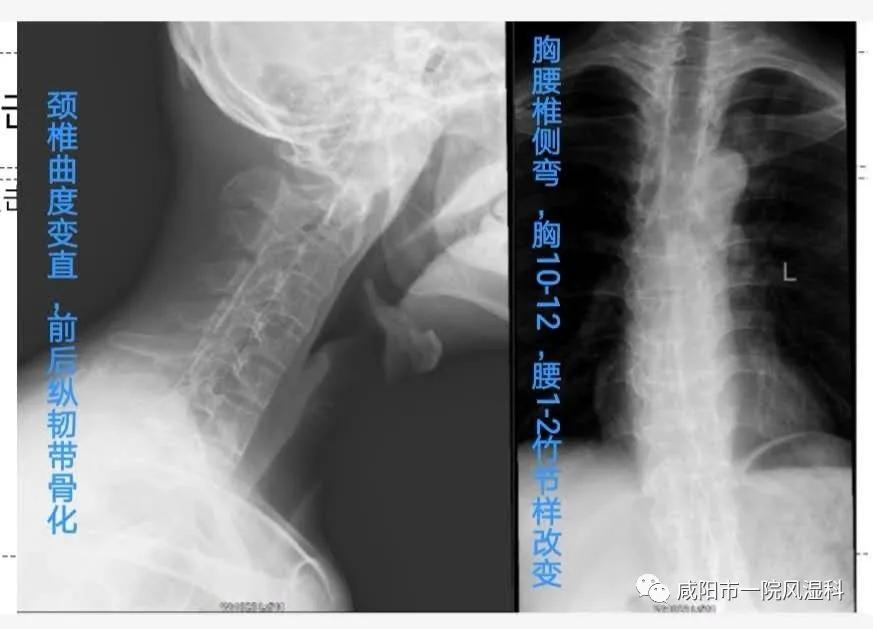 强直性脊柱炎号称不死的癌症,咸阳市强直性脊柱炎定点医院