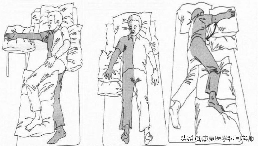 脑卒中后偏瘫患者常见并发症：肩手综合征的康复治疗