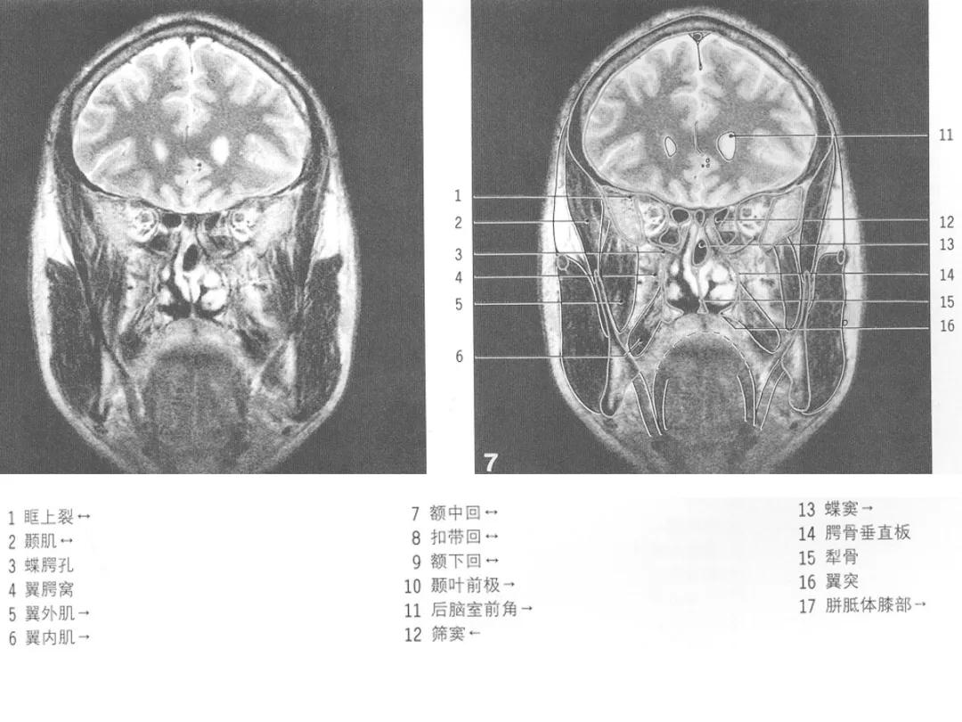 颅脑冠状状切面解剖图,颅脑mr解剖结构图