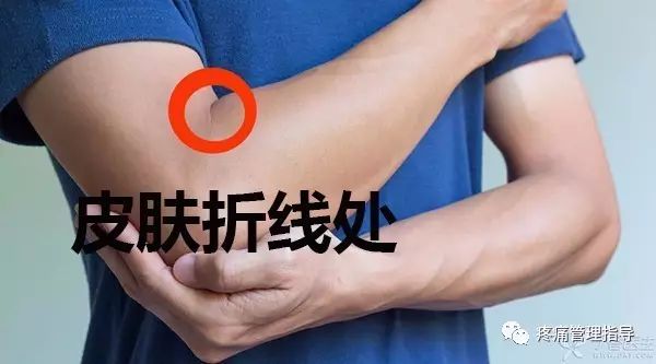 网球肘能自我恢复吗,网球肘病因的解剖学研究