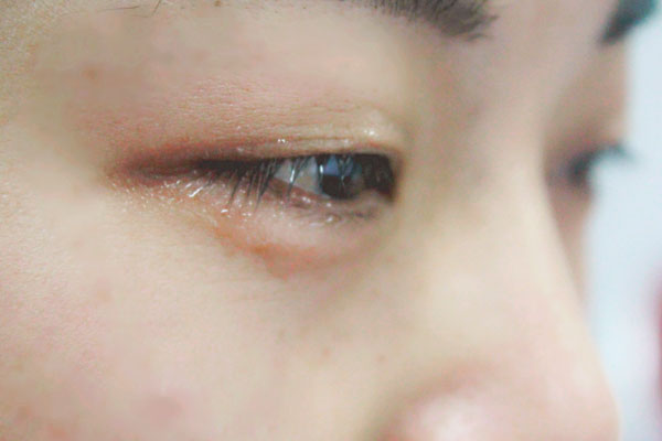 眼皮一直抽搐跳动什么原因,老人眼皮不受控制跳动