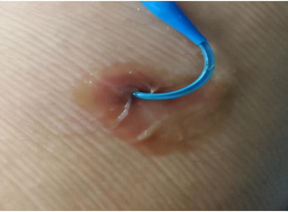 碘伏治疗PICC导管穿刺点感染的体会