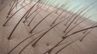 头皮毛囊炎治疗彻底根除全过程,头皮毛囊炎会导致秃头吗