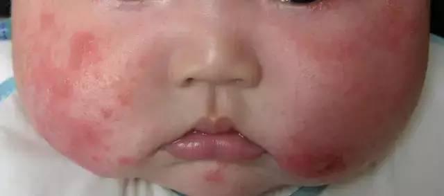 宝宝长湿疹妈妈的痛点,帮我分析一下宝宝长湿疹