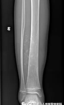 这个病例让我大涨知识：14岁男性右小腿痛性包块