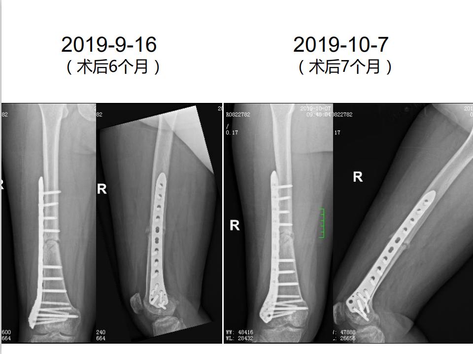 平乐骨科推拿教学,中医治疗骨折畸形愈合