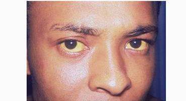 眼睛干涩容易疲劳吃什么药,眼睛干涩喝什么茶养肝明目