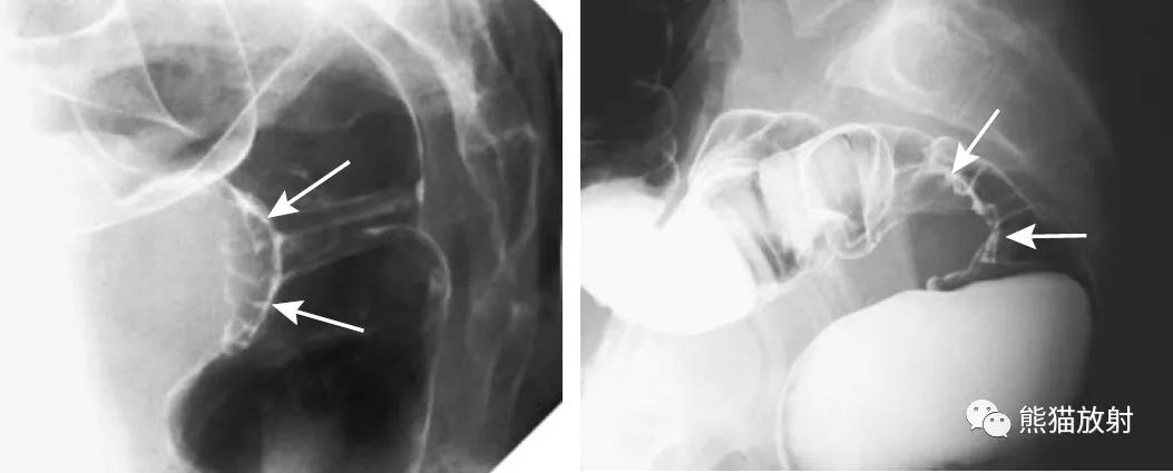 腹部影像图片大全,乙状直肠疼痛位置图片