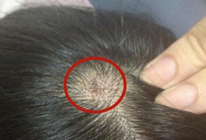 头皮长了个疙瘩破了怎么办,头皮为啥老长粉刺之类的疙瘩