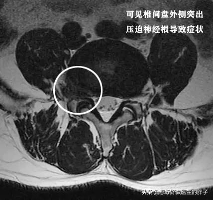 腰椎间盘突出核掉椎管里怎么治疗,腰椎间盘髓核掉进椎管严重吗