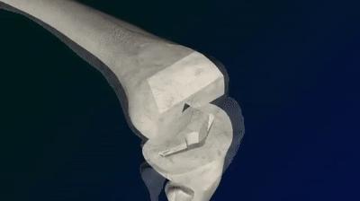 颈椎骨质增生的手术治疗风险大吗,关节边缘骨质增生最佳治疗方法