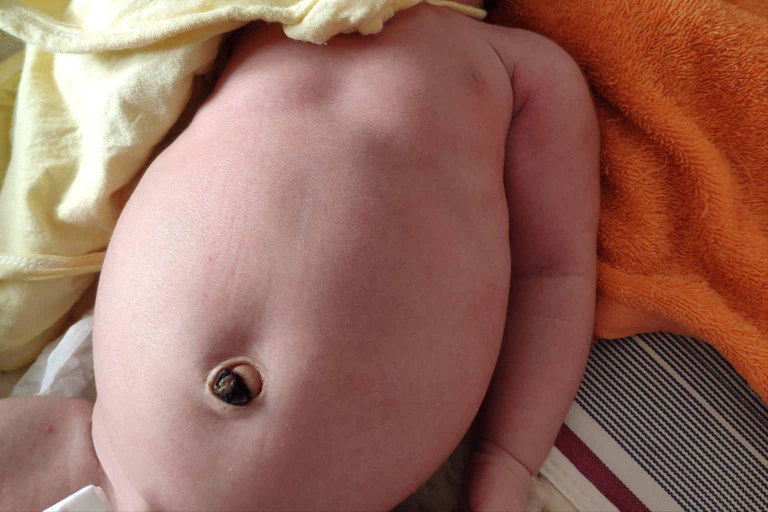 肚子胀气大便排不干净,肚子胀气大便排不出