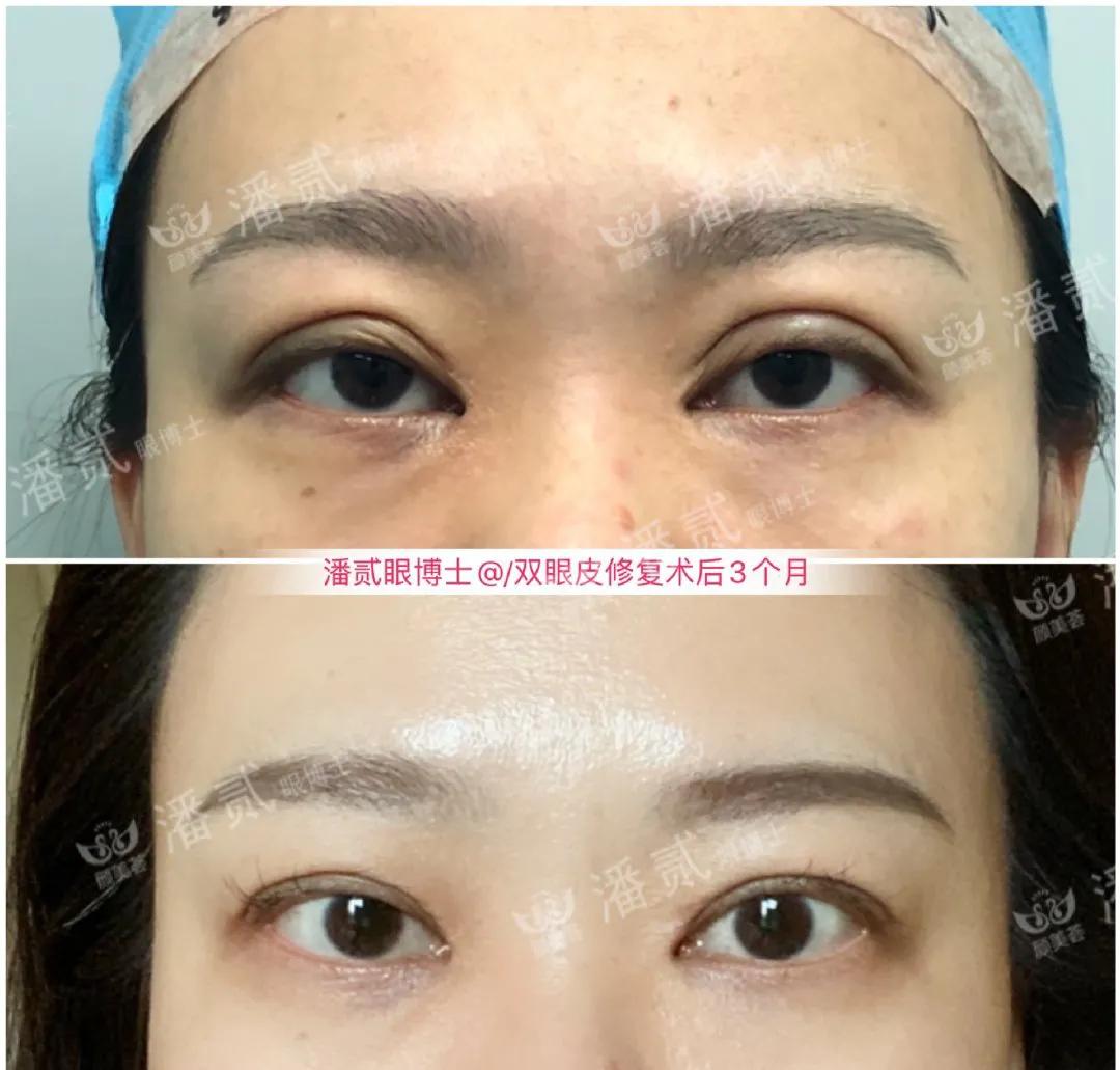 双眼皮修复改扇形双眼皮,平行双眼皮能改成开扇形双眼皮吗