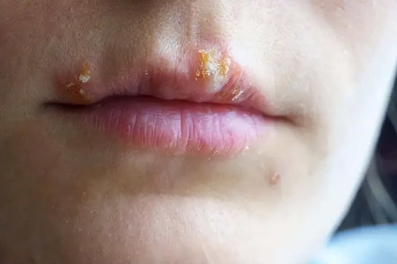 嘴上出了好多透明水泡会传染吗,嘴上起水泡是什么原因传染吗