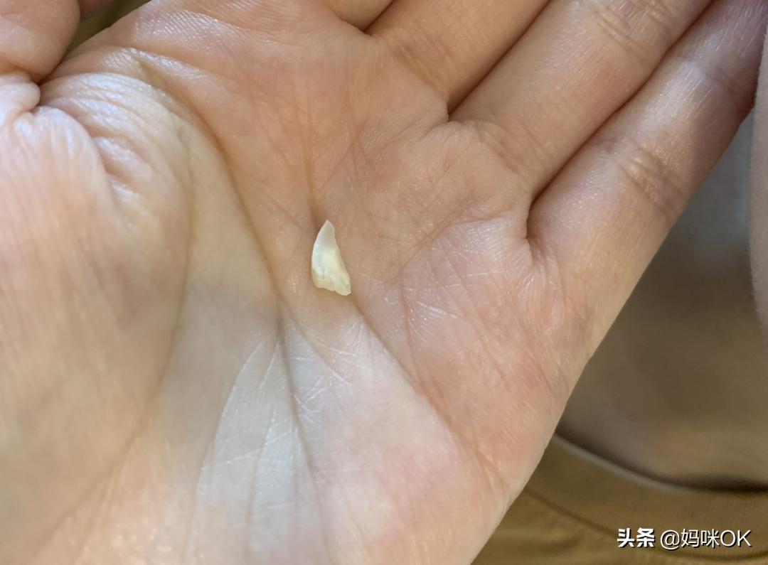 18岁前不能再用门牙吃东西！儿子的这一跤摔得有点惨痛