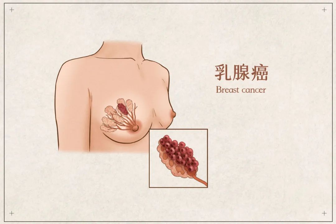20岁得乳腺癌的治愈的几率,20岁得了乳腺癌是什么原因