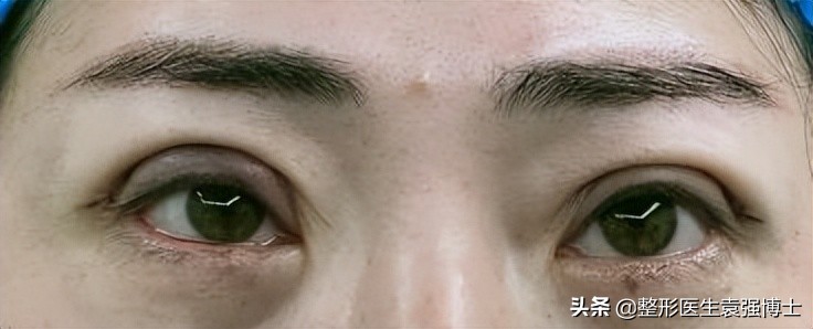 眼周年轻化手术效果可以持续多久,眼周医美项目