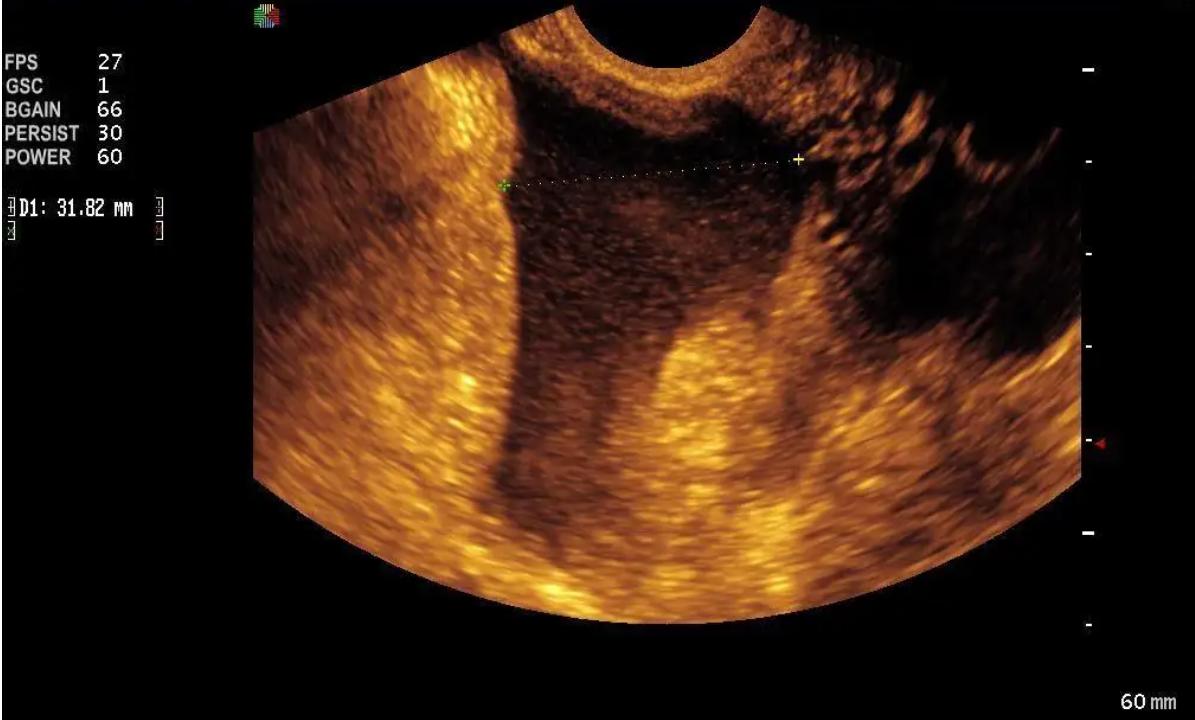 盆腔积液=盆腔炎？不要被它吓破了胆，范主任给你讲清楚、调正常