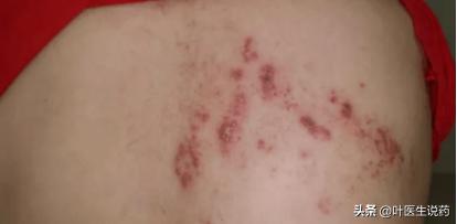 春季室内潮湿细菌感染怎么办,天气热容易霉菌感染用什么药