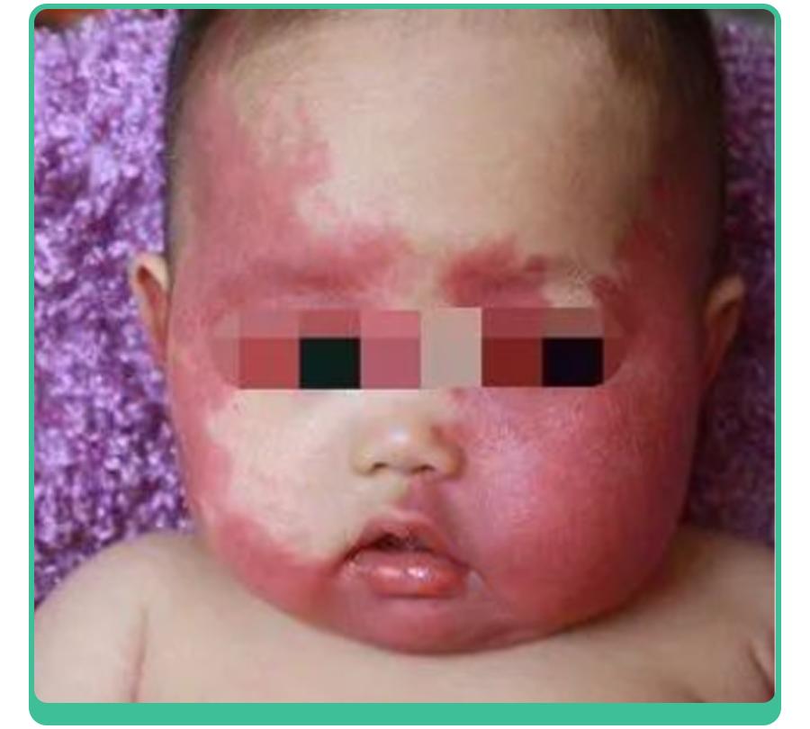 宝宝手上长胎记，一查竟是血管瘤！医生：这5种胎记要早处理