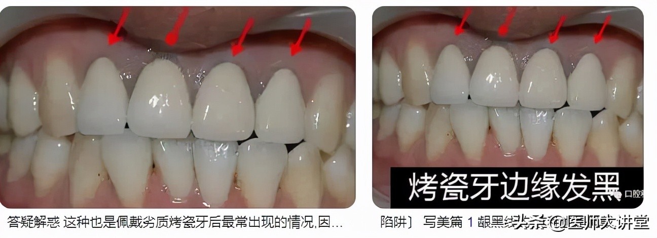 牙科医院做一个假牙大概多少钱,做假牙最便宜的多少钱一颗