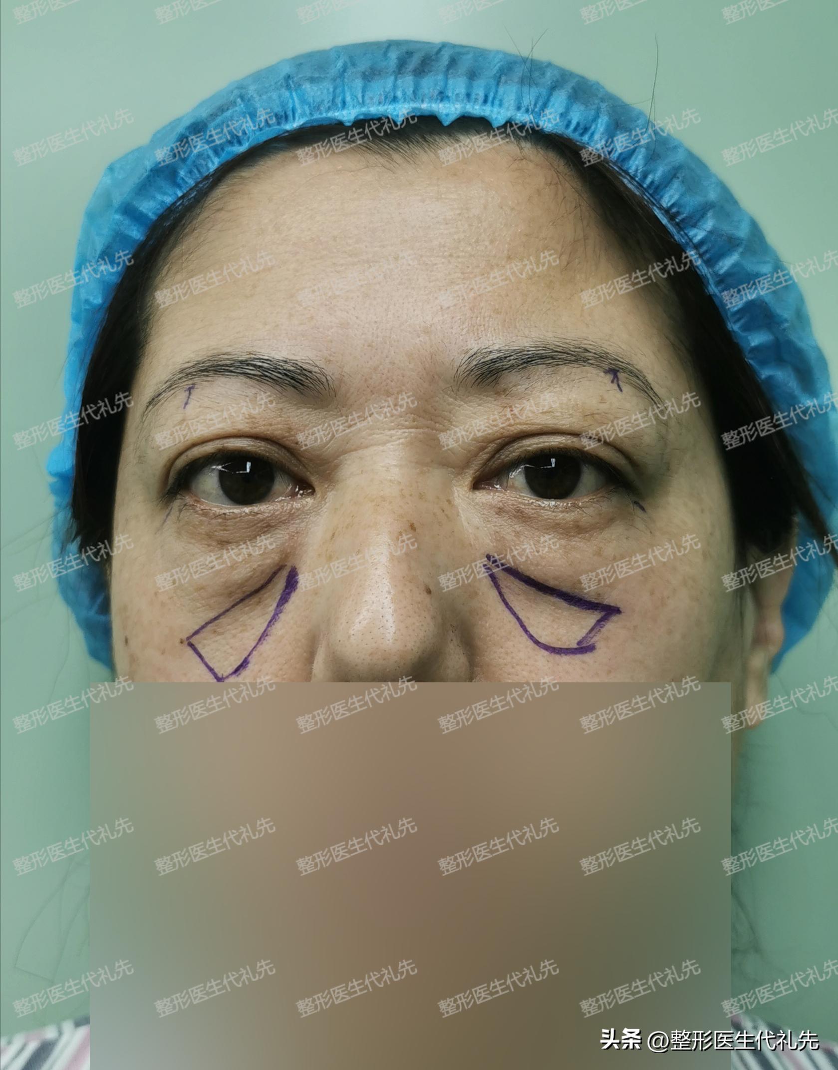 祛眼袋手术后凹陷多久恢复好,祛眼袋手术后眼眶处出现凹陷