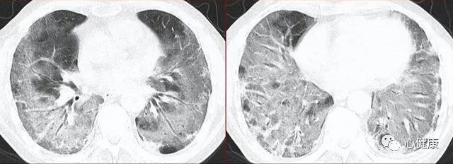 白肺是新冠病毒造成的吗,新冠肺炎白肺会引起纤维化吗