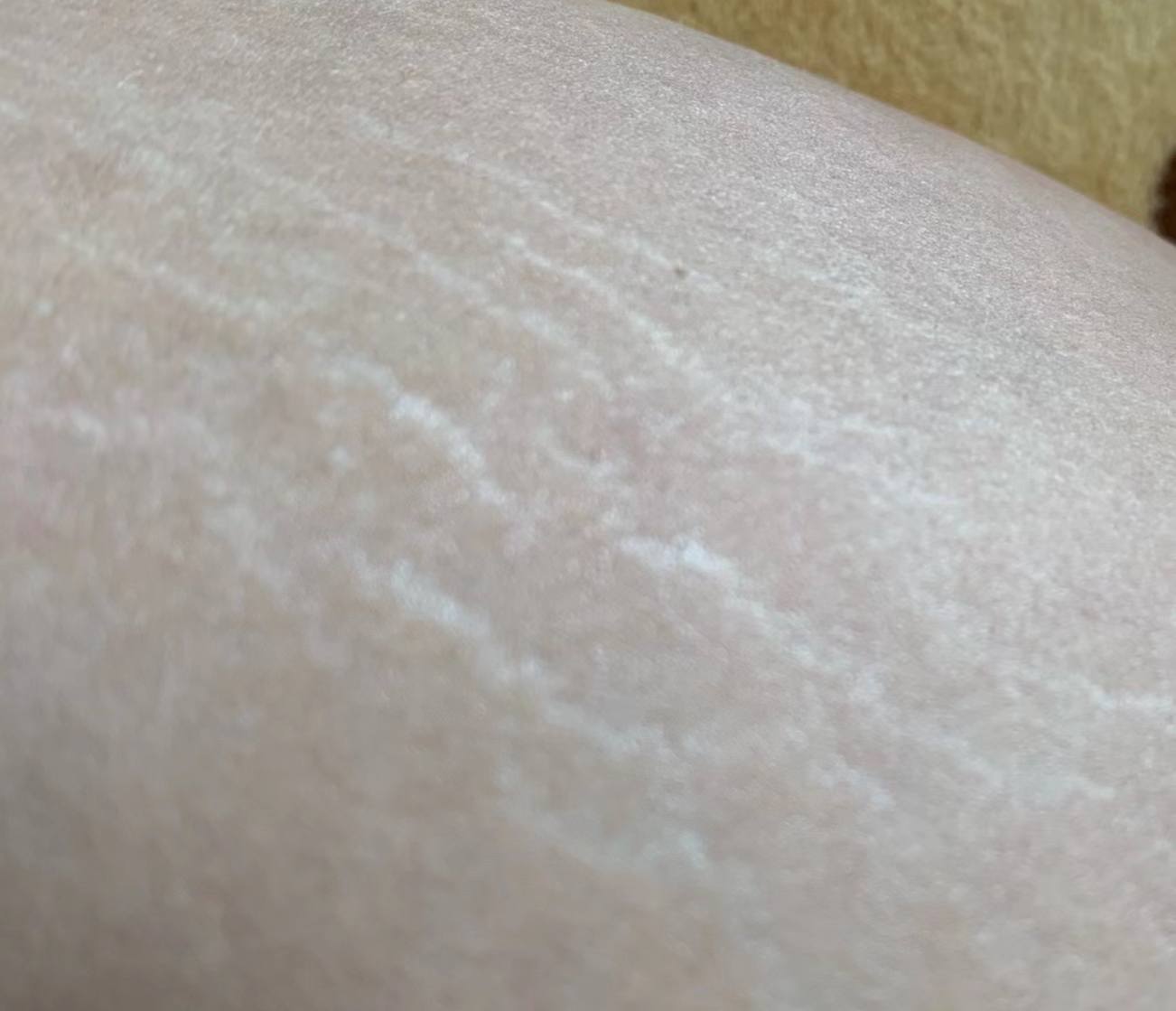 红色肥胖纹和白色肥胖纹淡化,肥胖纹能彻底消除吗