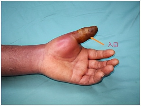 手指被牙签扎了没流血有脓液,手指被扎了一下没有破但是有红点