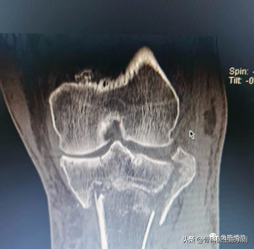 膝关节胫骨平台骨折,最近胫骨平台骨折视频