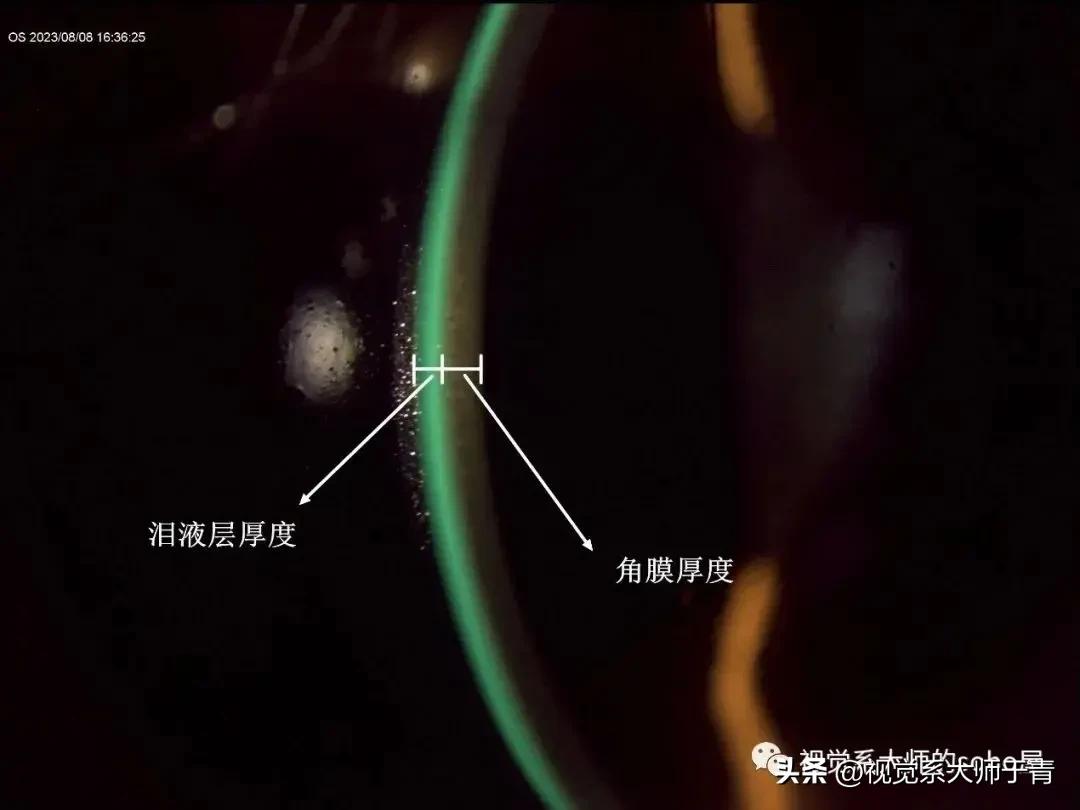 巩膜镜的验配技巧及案例分享,试戴巩膜镜成功率高不高