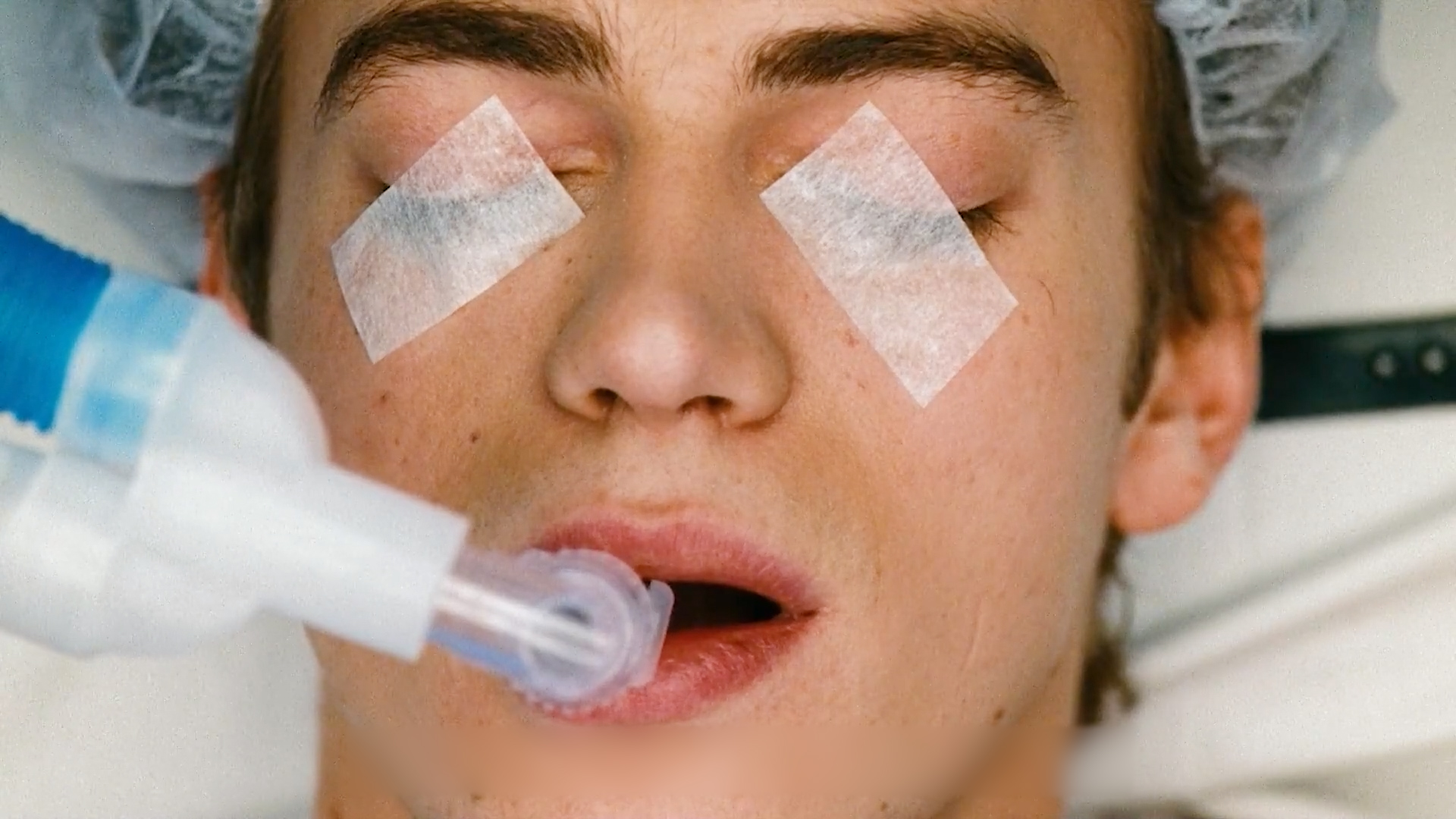 换瓣手术麻醉后遗症,换心手术并发症